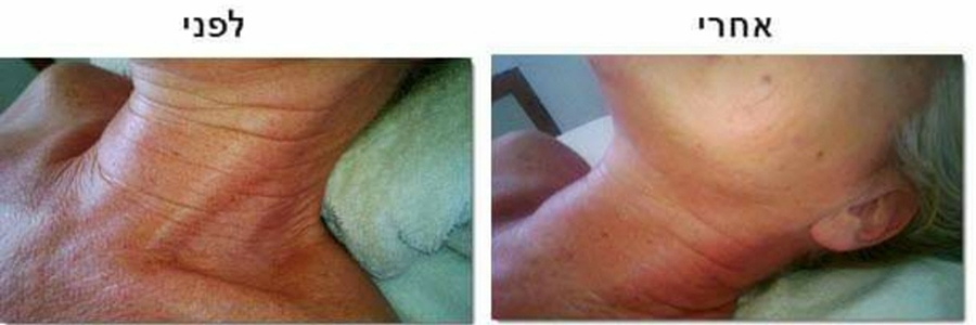 פייסליפטינג