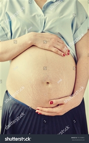 סימני מתיחה מפריעות לך?