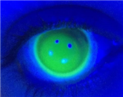 Fluorescein pattern