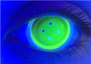 Proper Central Corneal Clearance - Correct Sag